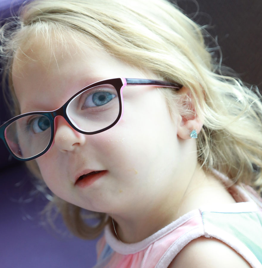 Young girl with glasses, cleft palate. Young girl with glasses, cleft palate.
